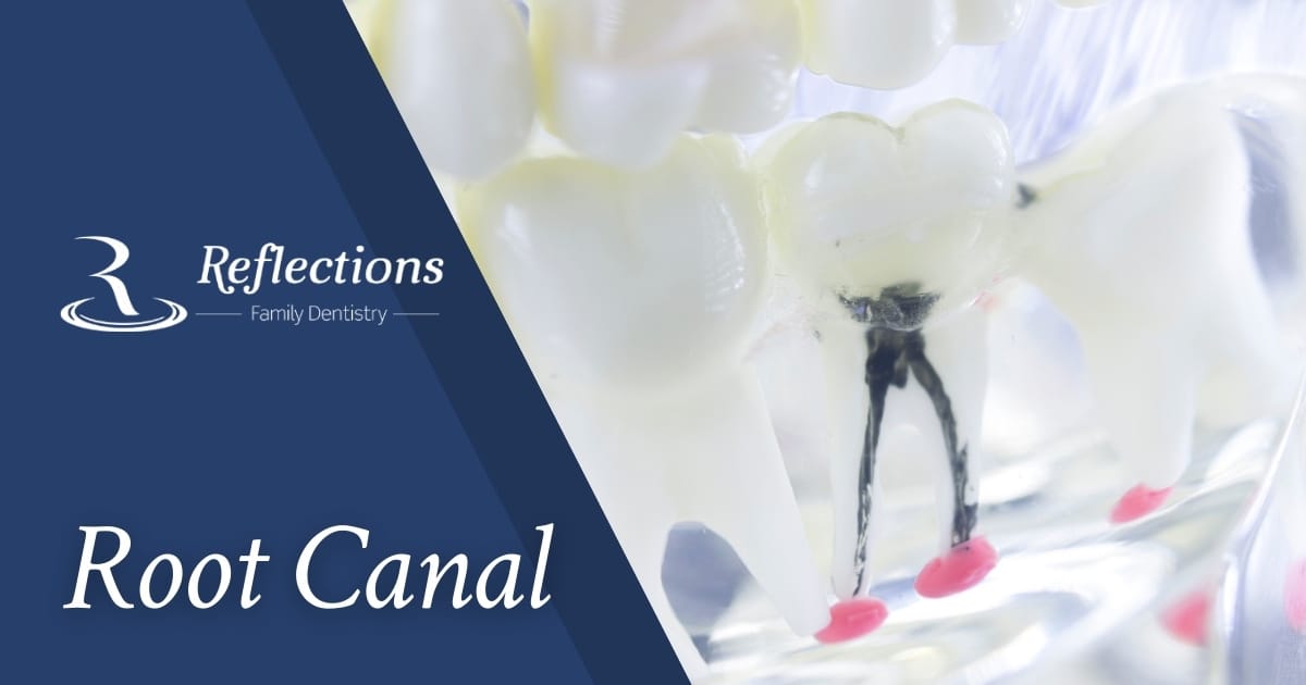 Root Canal — Reflections Family Dentistry — Granite Bay, CA