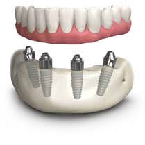 Implant supported denture by TeethXpress