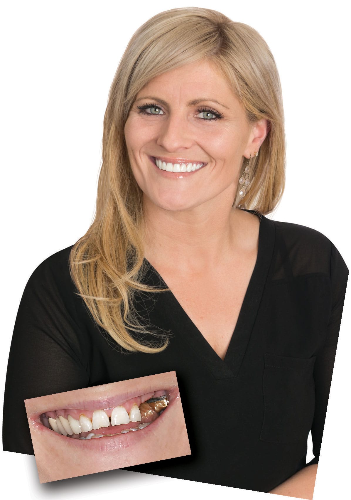 Carly age 39, TeethXpress patient, great teeth.