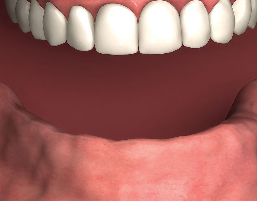 Typical patient with missing teeth