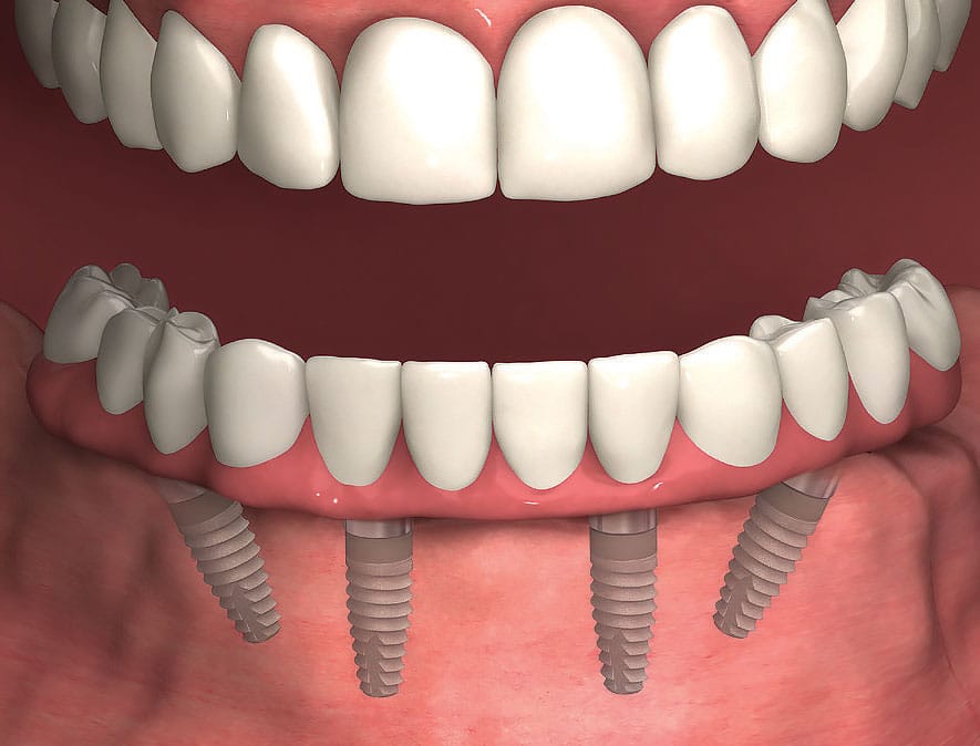 Teeth are attached to the implants to function like natural teeth.