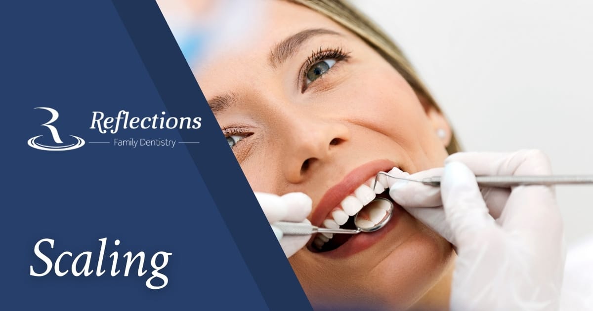 What is Tooth Scaling? — Reflections Family Dentistry — Granite Bay, CA